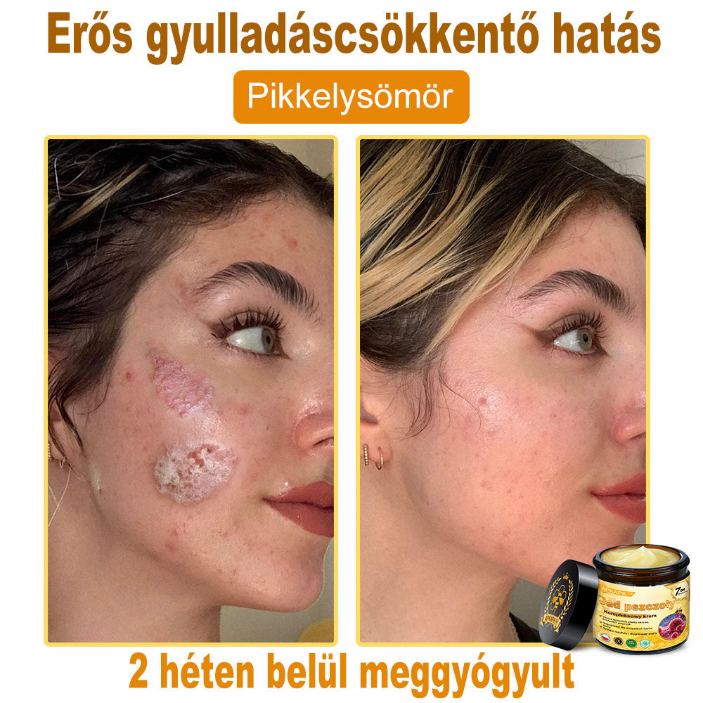 🐝PUROSA® Méhméreg Bőrmegújító Krém|✅Teljes körű megoldás a makacs bőrproblémák, például az öregedés, ekcéma, hegek és pikkelysömör ellen