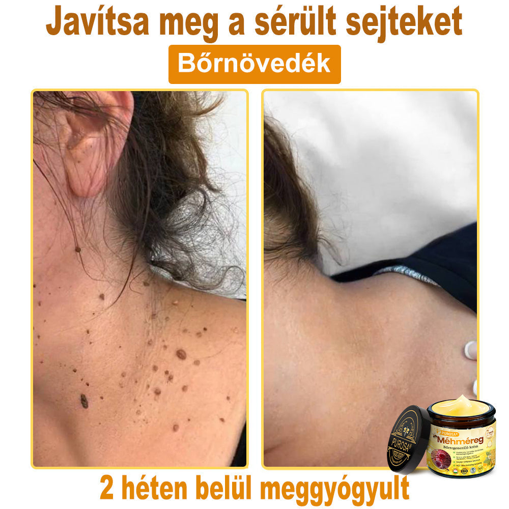 🐝PUROSA® Méhméreg Bőrmegújító Krém|✅Teljes körű megoldás a makacs bőrproblémák, például az öregedés, ekcéma, hegek és pikkelysömör ellen