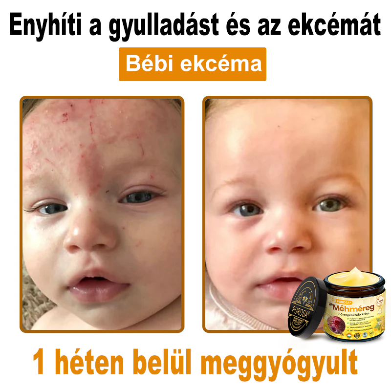 🐝PUROSA® Méhméreg Bőrmegújító Krém|✅Teljes körű megoldás a makacs bőrproblémák, például az öregedés, ekcéma, hegek és pikkelysömör ellen
