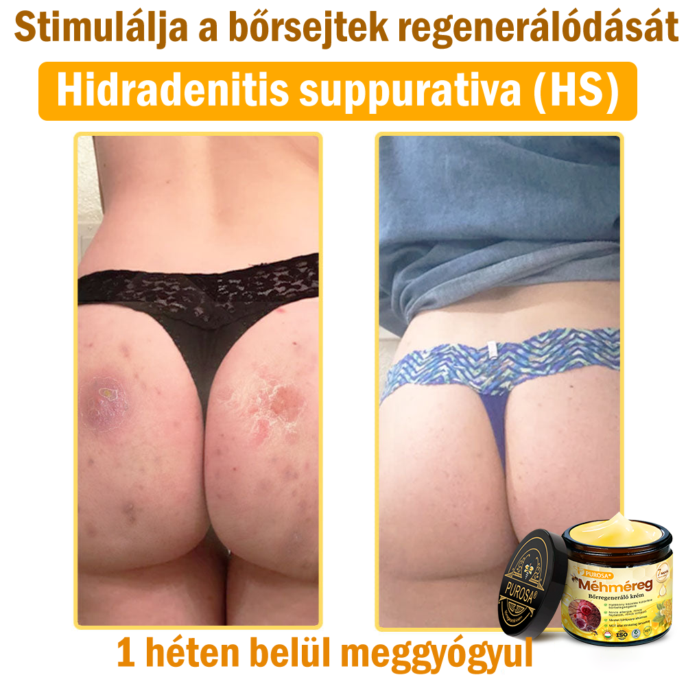 🐝PUROSA® Méhméreg Bőrmegújító Krém|✅Teljes körű megoldás a makacs bőrproblémák, például az öregedés, ekcéma, hegek és pikkelysömör ellen
