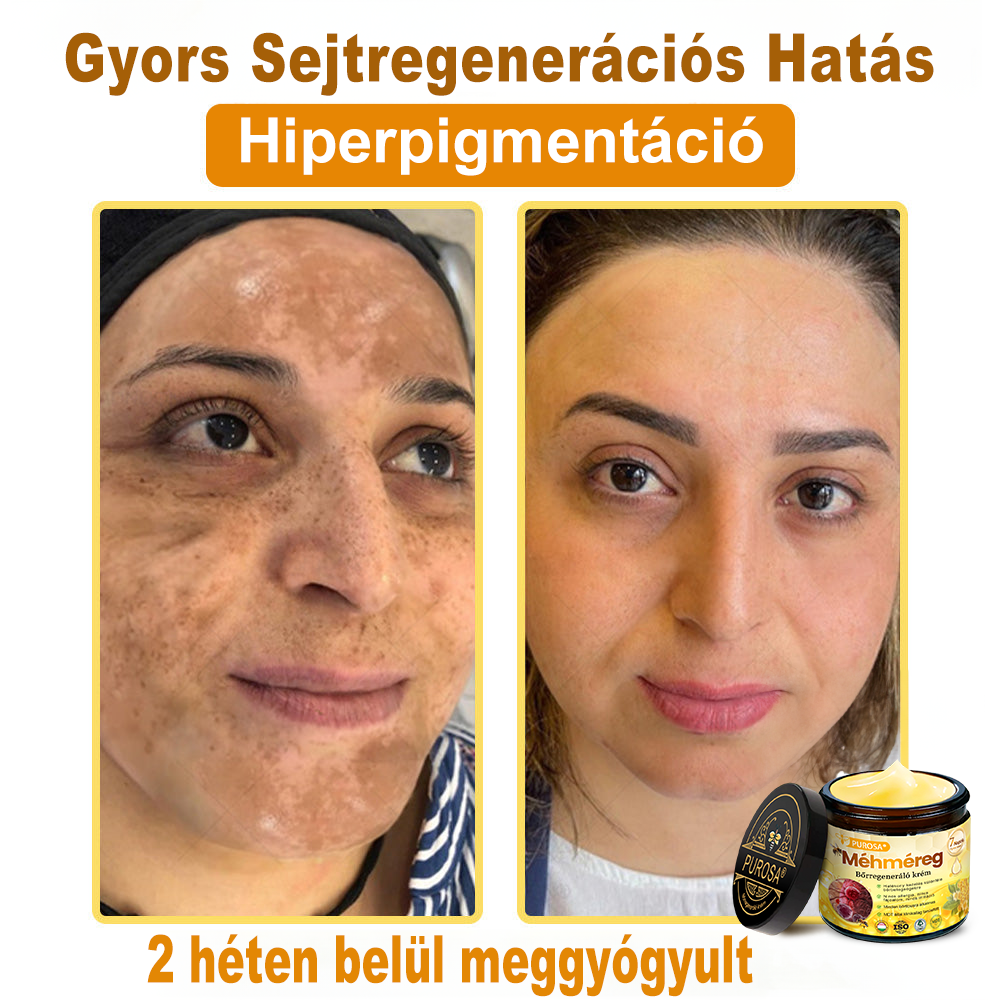 🐝PUROSA® Méhméreg Bőrmegújító Krém|✅Teljes körű megoldás a makacs bőrproblémák, például az öregedés, ekcéma, hegek és pikkelysömör ellen